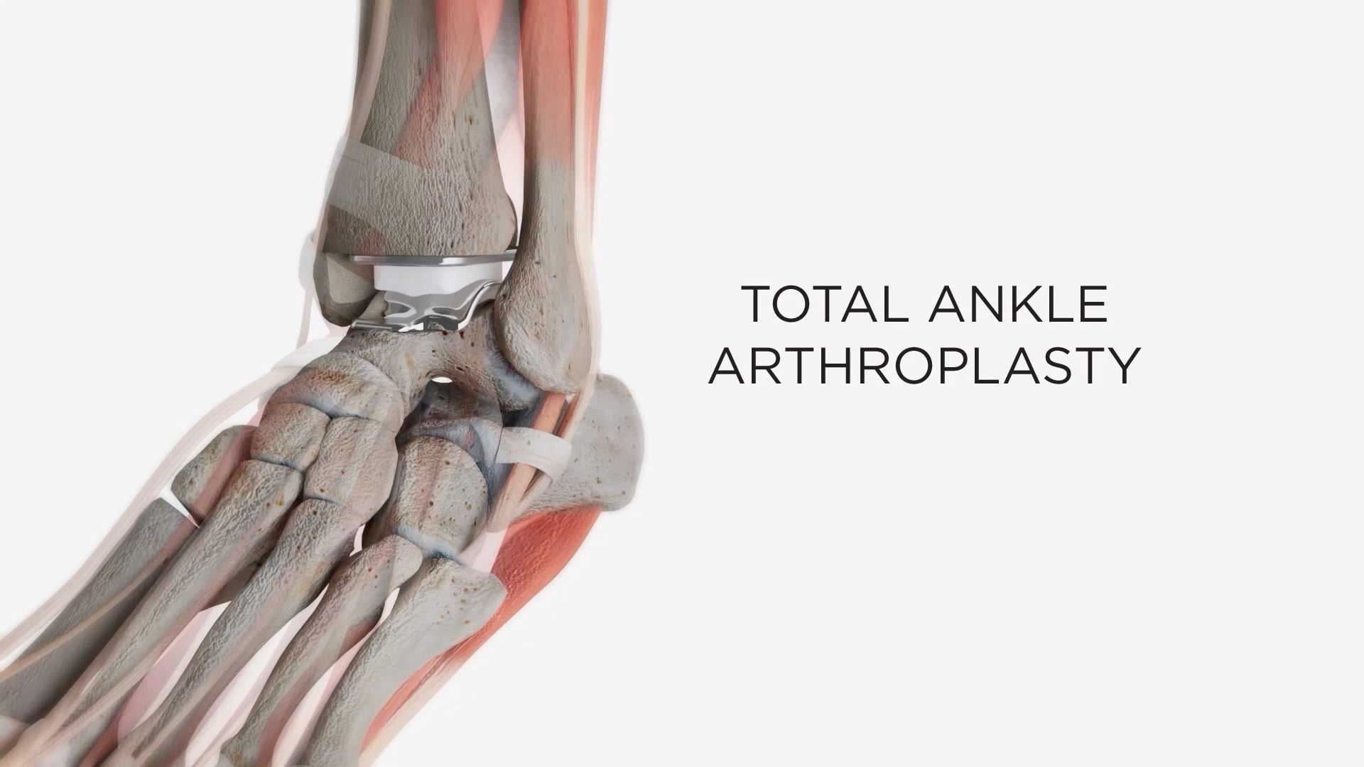 Vantage Ankle Mobile Bearing Patient Animation